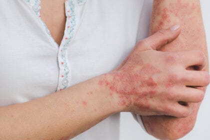 psorijaza-bolesti-koze