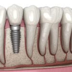 zubni-implant
