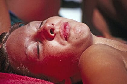 zena-suncanje-crvenilo