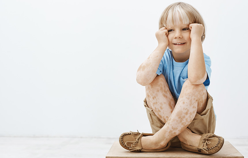 kozna-bolest-vitiligo-decak