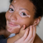 vitiligo-zena-sa-detetom