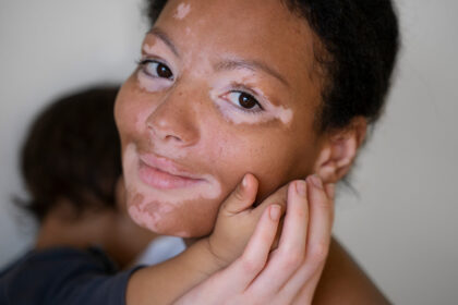 vitiligo-zena-sa-detetom