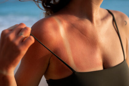 devojka-sunce-crvenilo-koze